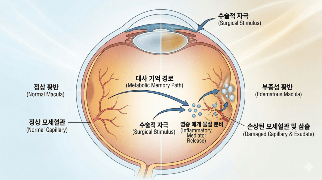당뇨 환자의 눈 내부 미세 혈관이 백내장 수술적 자극으로 인해 염증 물질을 분비하여 망막 중심부인 황반이 물이 차듯 부어오르는 황반부종 현상을 보여주는 직관적이고 현대적인 메디컬 일러스트