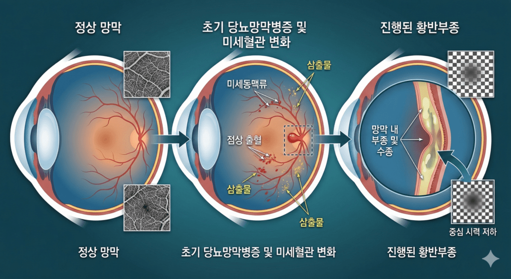 시력 1.0인데 당뇨망막병증? 동래구 안과 주치의가 말하는 망막 주사 최신 트렌드와 산동 검사의 중요성 2 당뇨망막병증으로 인한 망막 모세혈관의 변화와 황반부종의 진행 과정을 보여주는 깔끔한 메디컬 일러스트