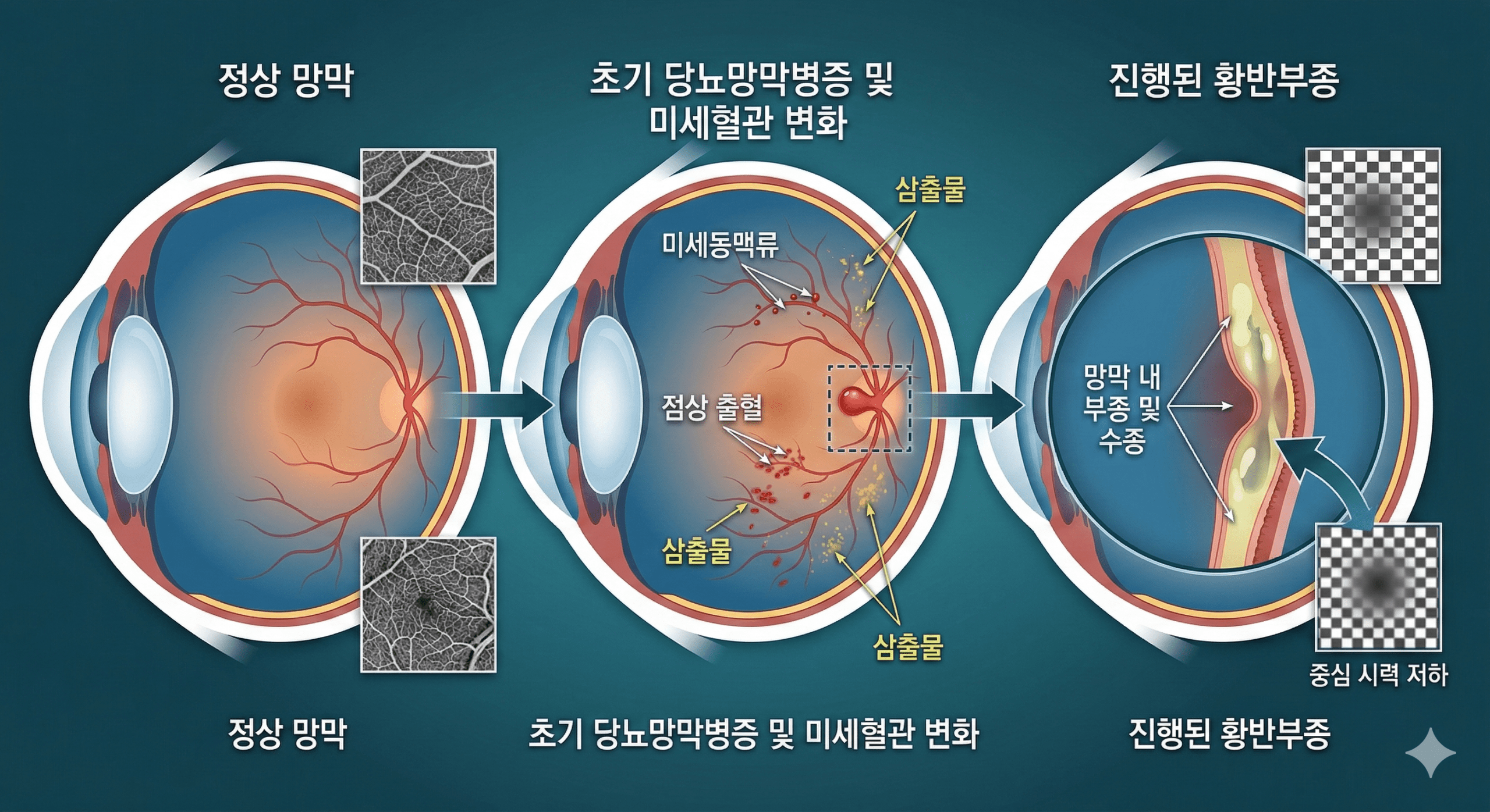 당뇨망막병증으로 인한 망막 모세혈관의 변화와 황반부종의 진행 과정을 보여주는 깔끔한 메디컬 일러스트