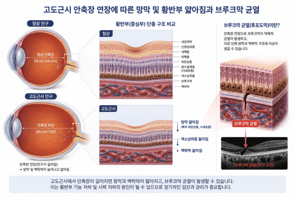 고도근시 안축장 연장에 따른 망막 및 황반부 얇아짐과 브루크막 균열 메디컬 일러스트