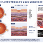 고도근시 황반변성