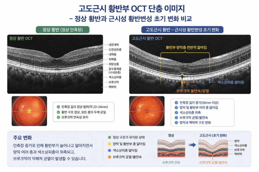 고도근시 황반부 OCT 단층 이미지 - 정상 황반과 근시성 황반변성 초기 변화 비교 일러스트