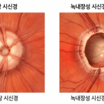 정상 시신경과 녹내장성 시신경 유두 함몰의 3차원적 미세 구조 차이를 비교하여 보여주는 깨끗한 메디컬 3D 일러스트