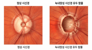 시야 결손 전 골든타임 5년, 시신경단층촬영(OCT)이 필수적인 의학적 이유