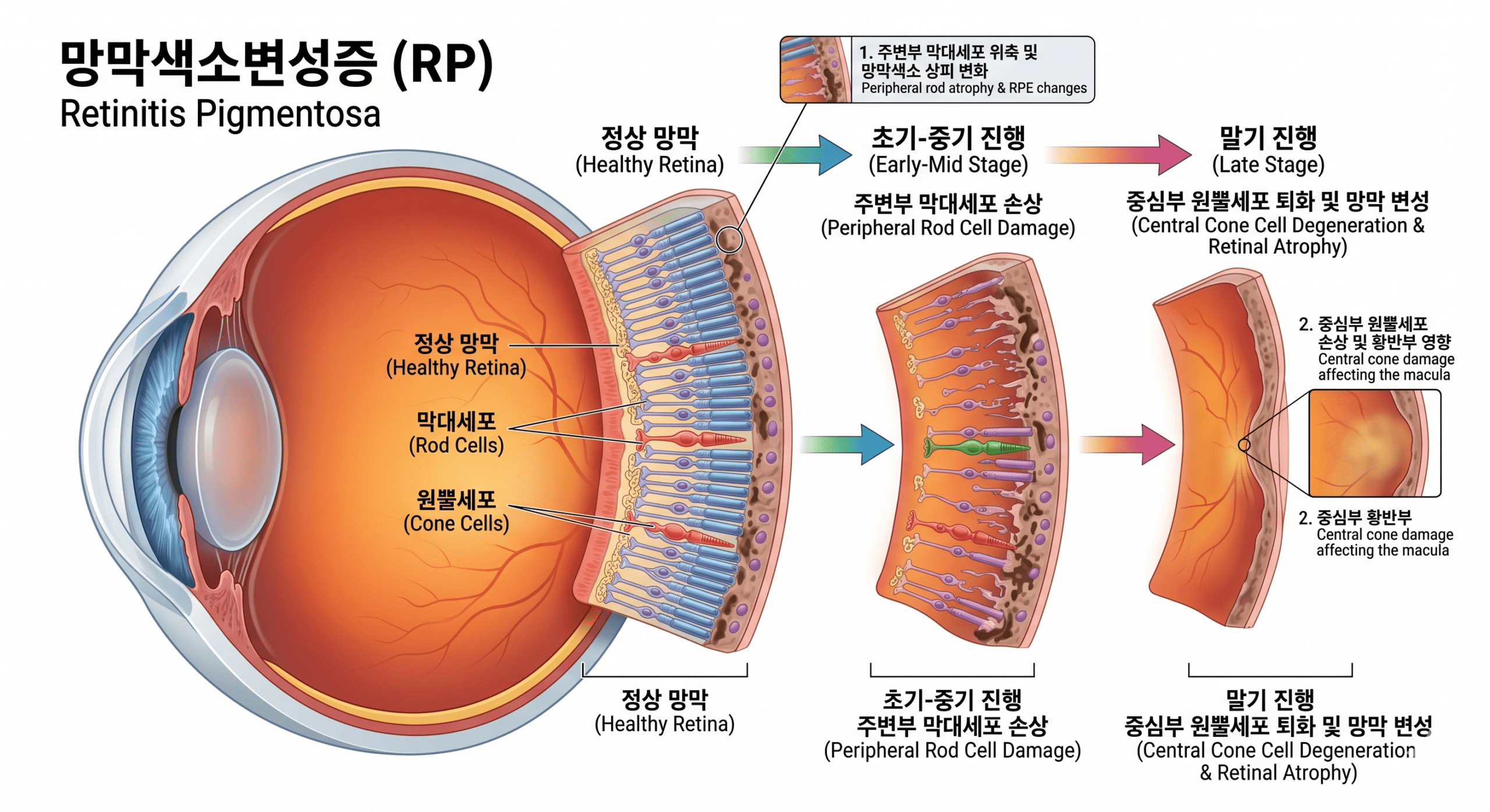 망막색소변성증 환자의 중심 시력 보존 전략: 2023년 미국안과학회(AAO) 지견을 중심으로 한 심층 분석 썸네일